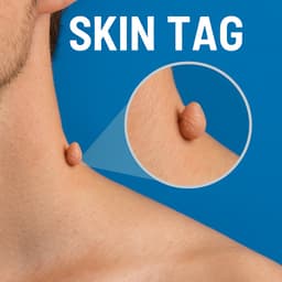 skin tags